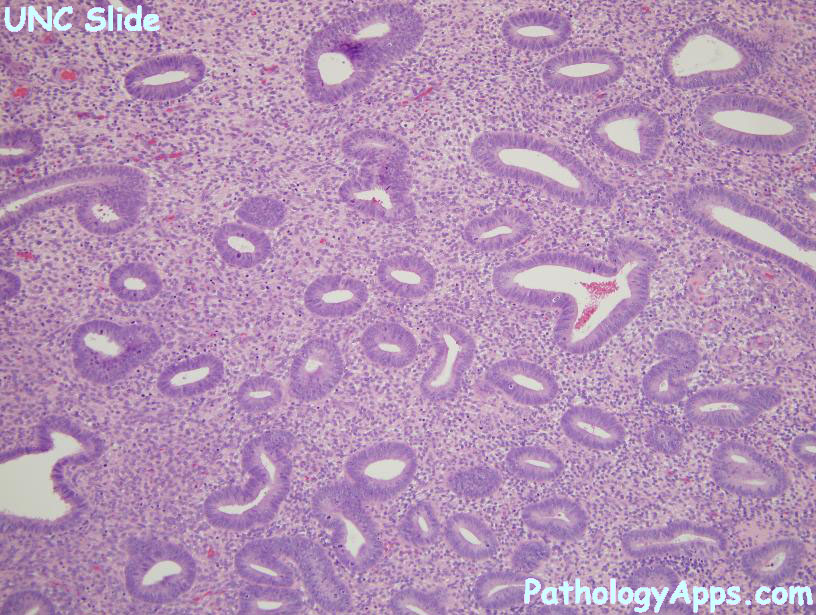 Endometrial Hyperplasia Pathology