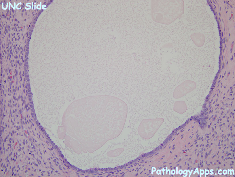 Cortical Inclusion Cyst Ovary Histology