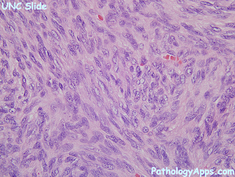 Dermatofibrosarcoma Protuberans Histology