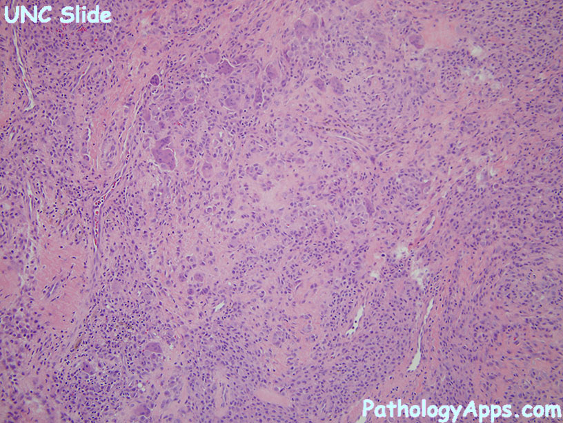 Giant Cell Tumor Of Tendon Sheath Soft Tissue Histology