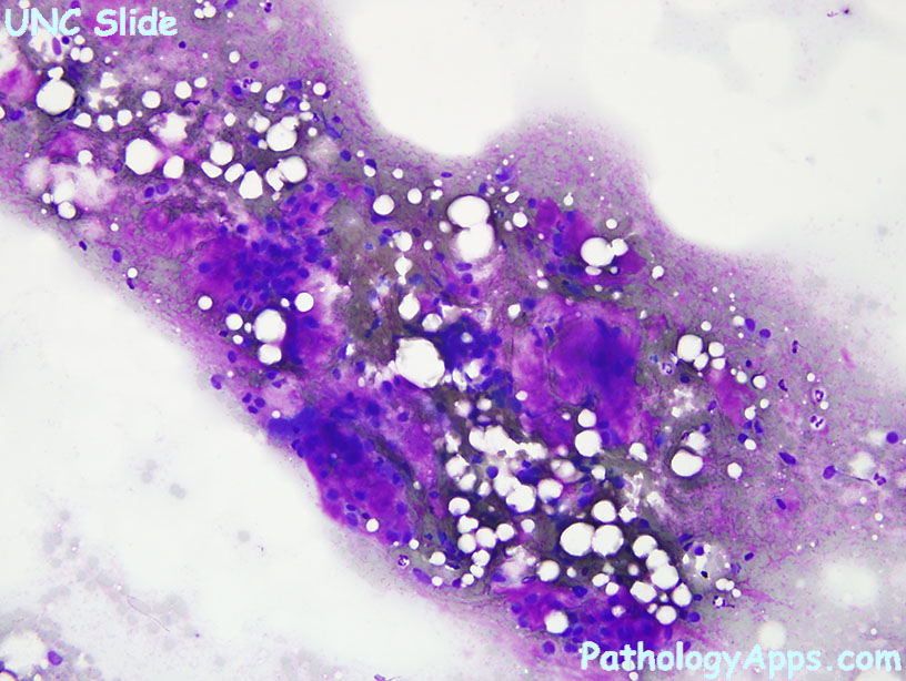 pleomorphic adenoma cytology)