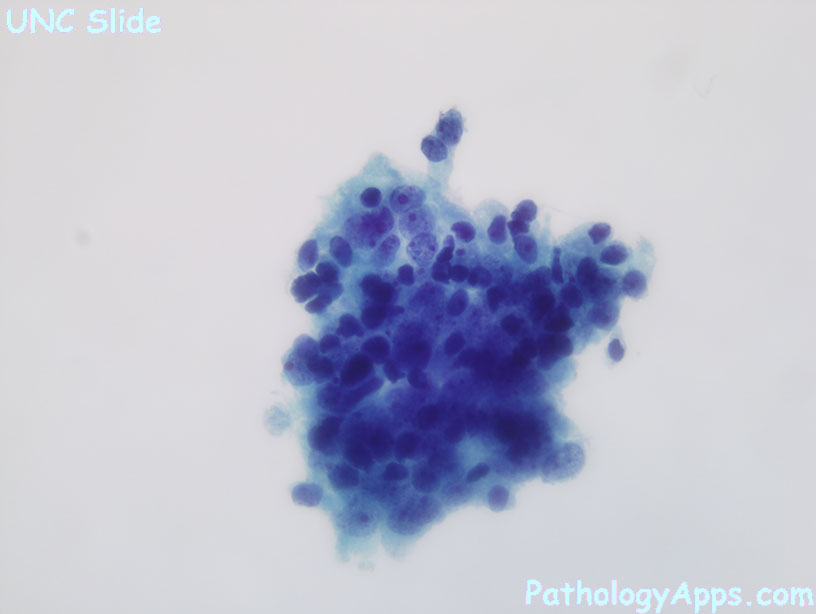 prostate adenocarcinoma cytology