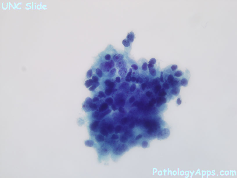 prostate adenocarcinoma cytology)