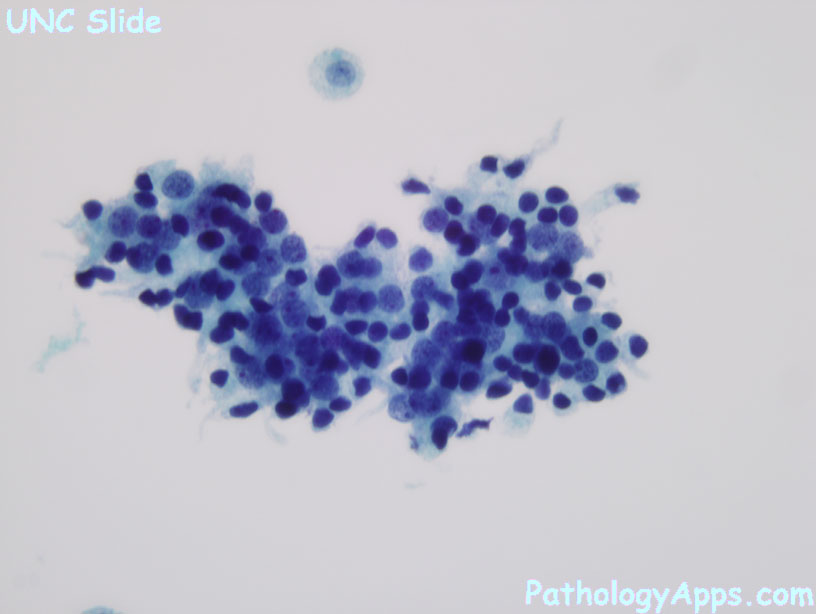prostate adenocarcinoma cytology