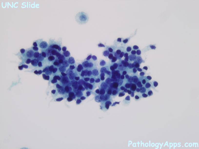 prostate adenocarcinoma cytology)