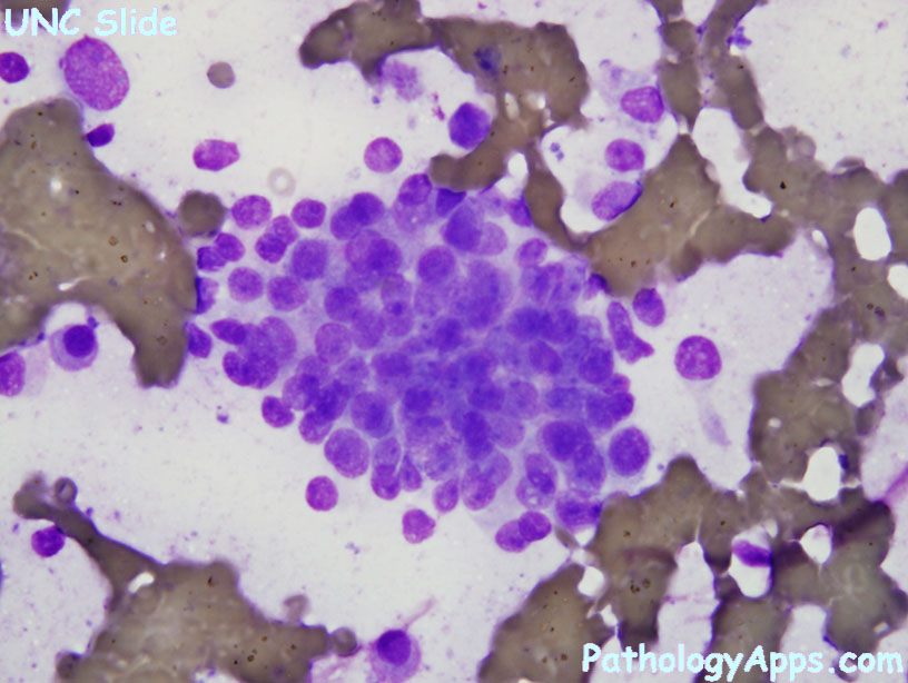 prostate adenocarcinoma cytology)