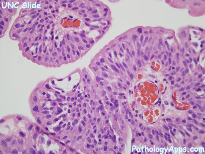 urothelialis papilloma hisztopathology
